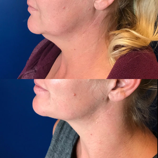 Kybella Near Me Kybella Before And After Kybella Treatment