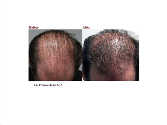 Hair Growth Derma Roller - Stimualtes hair growth – BondiBoostUK