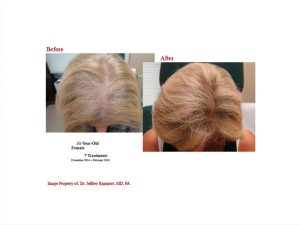 PRP Hair Before And Afters 10