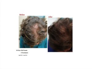 PRP Hair Before And Afters 12