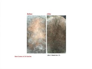 PRP Hair Before And Afters 2
