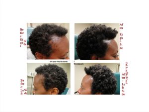 PRP Hair Before And Afters 9