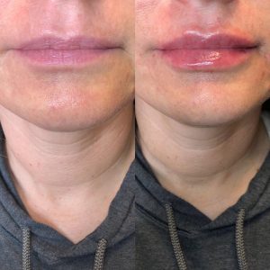 Michael Clark Juvederm Before & After Profile