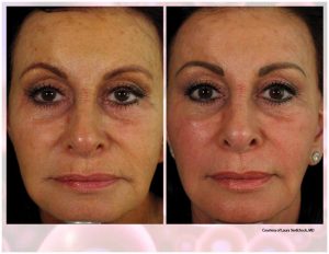 PRP Facial Before And After Facial 1
