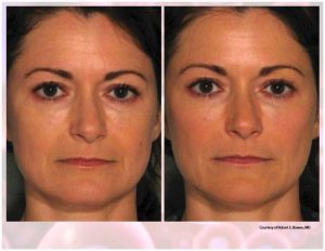 PRP Facial Before And After Facial 10
