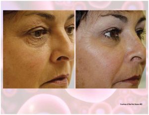 PRP Facial Before And After Facial 13
