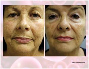 PRP Facial Before And After Facial 14