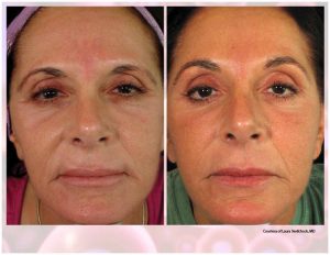PRP Facial Before And After Facial 3
