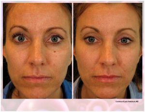 PRP Facial Before And After Facial 4