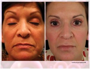 PRP Facial Before And After Facial 5