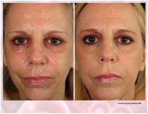 PRP Facial Before And After Facial 6