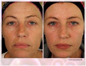 PRP Facial Before And After Facial 7