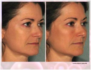 PRP Facial Before And After Facial 9