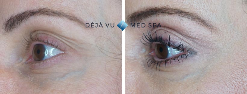 PRP Facial Before And After Facial