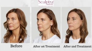 Sculptra Aesthetic Before And After