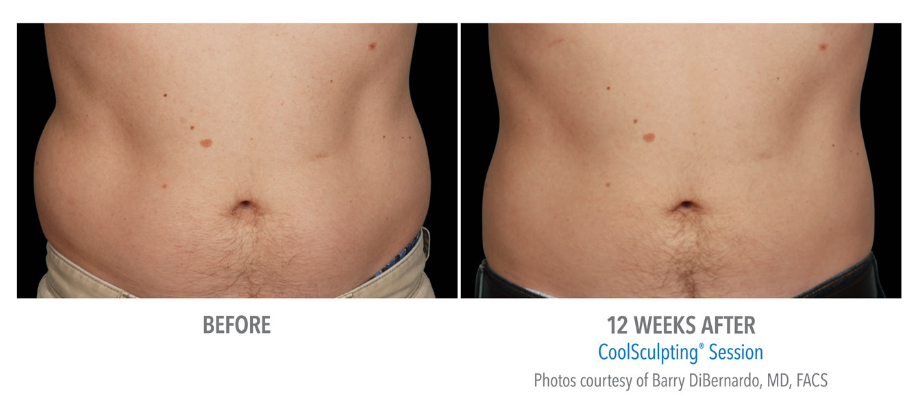Coolsculpting Near Me Coolsculpting Coolsculpting before and after