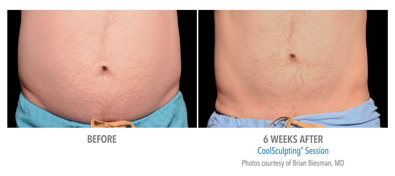 Coolsculpting Near Me Coolsculpting Coolsculpting before and after