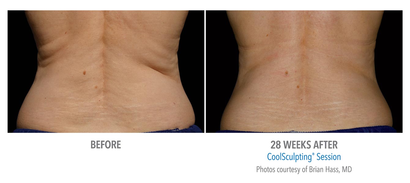 Coolsculpting Near Me Coolsculpting Coolsculpting before and after