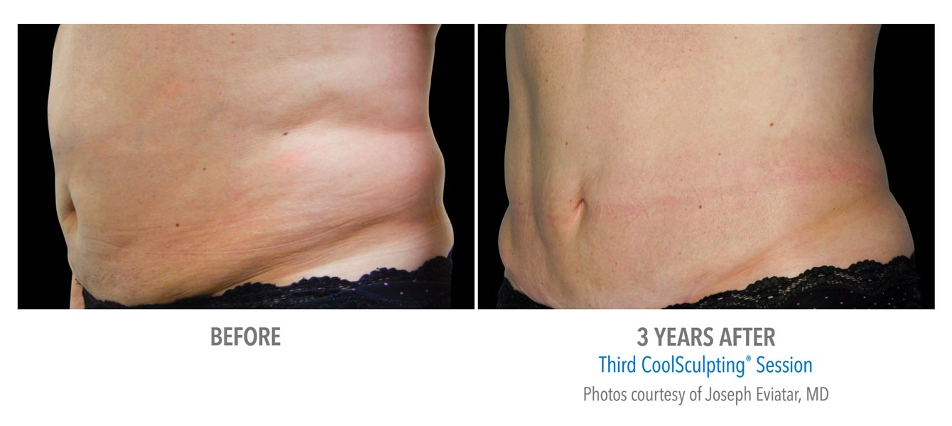 Coolsculpting Near Me Coolsculpting Coolsculpting before and after