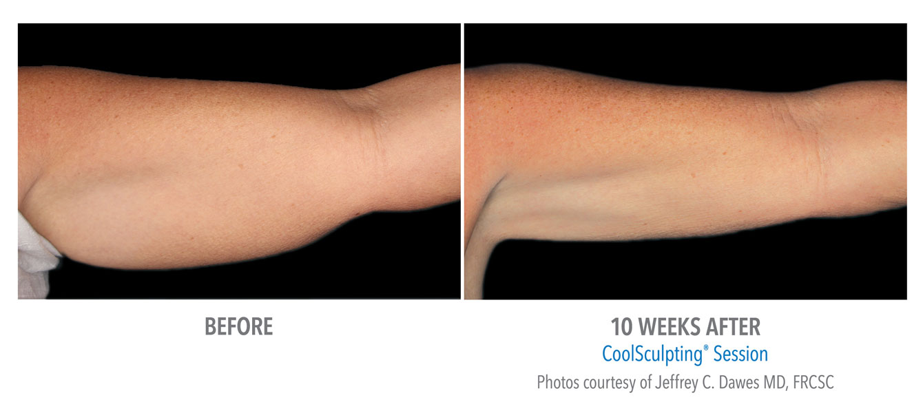 Coolsculpting Near Me Coolsculpting Coolsculpting before and after
