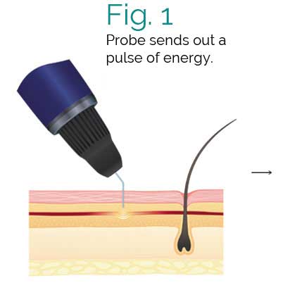 Deja Vu Medspa Thermavein Process Fig 1