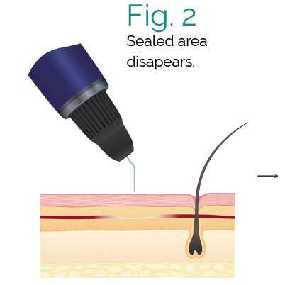 Deja Vu Medspa Thermavein Process Fig 2