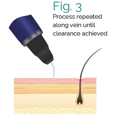 Deja Vu Medspa Thermavein Process Fig 3