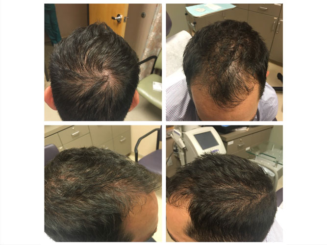 PRP Hair Restoration | PRP Hair Restoration Near Me | Read Our Reviews