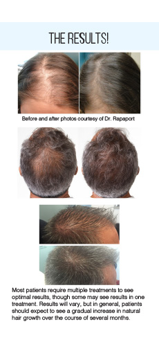 PRP Hair Restoration Rack Card