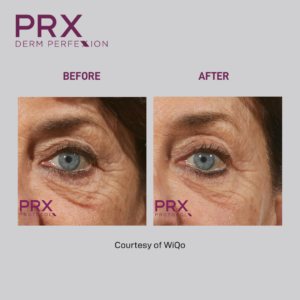 Before and After PRX Peel